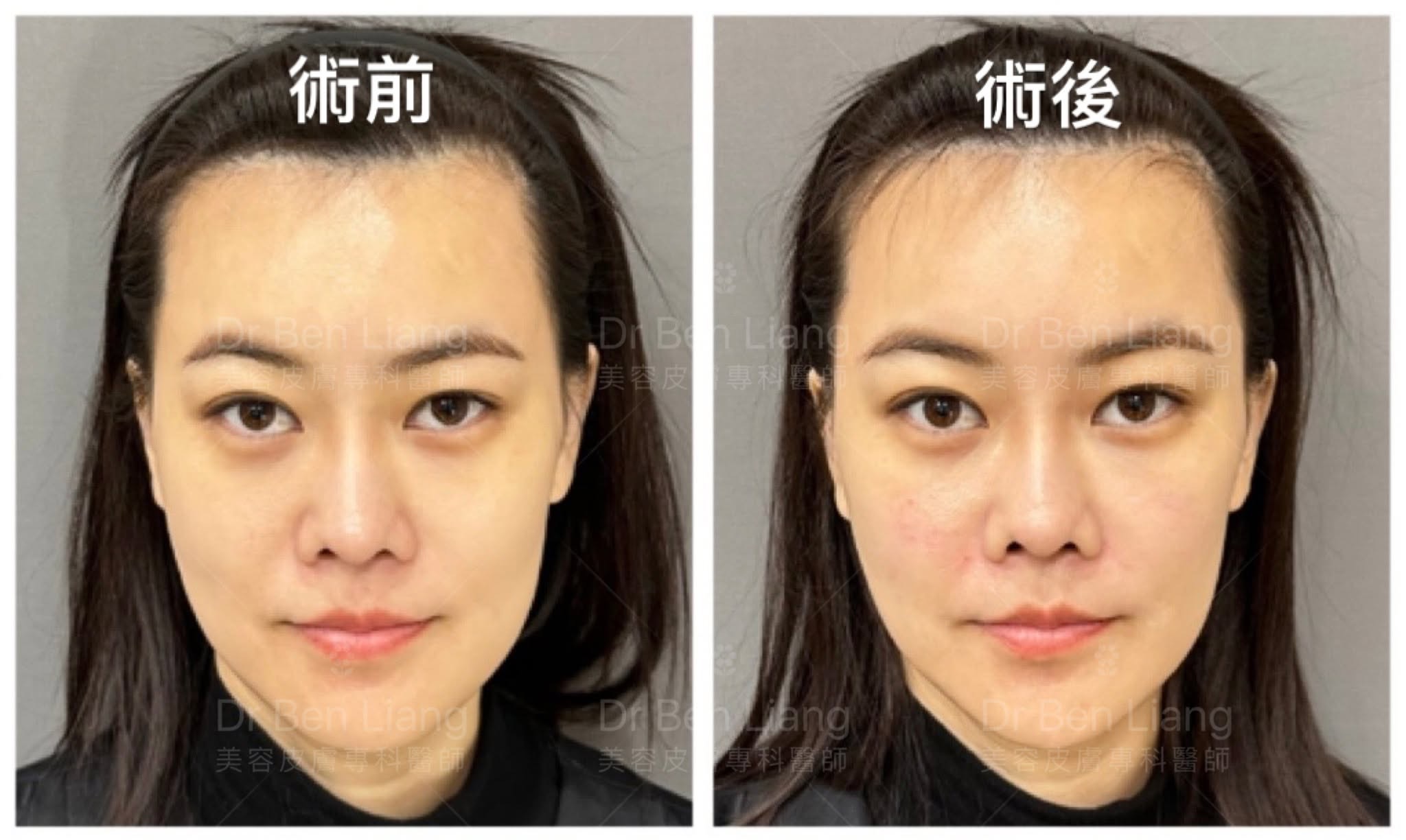 術前術後中臉支撐與光影改善比較